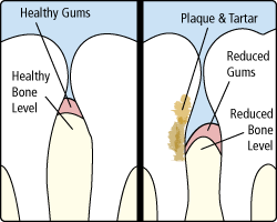 Gundersen Dental is your choice for a dentist in Tumwater, WA. Periodonatal disease