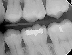 Gundersen Dental is your choice for a dentist in Tumwater, WA. Cavity fillings