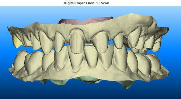 Full Mouth Restoration - Gundersen Dental is your Tumwater Dentist - Dentist Near Tumwater