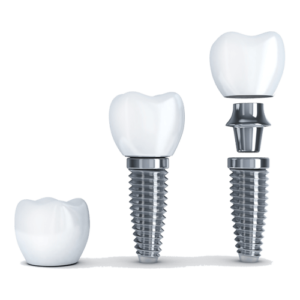Gundersen Dental is your choice for a dentist in Tumwater, WA. Dental Implants
